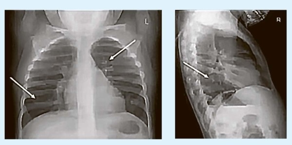 
        Кашель у детей: особенности дифференциальной диагностики                    