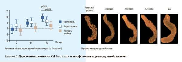 
        Ремиссия сахарного диабета 2-го типа: миф или реальность?                    