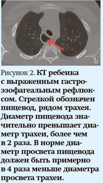 
        Кашель у детей: особенности дифференциальной диагностики                    