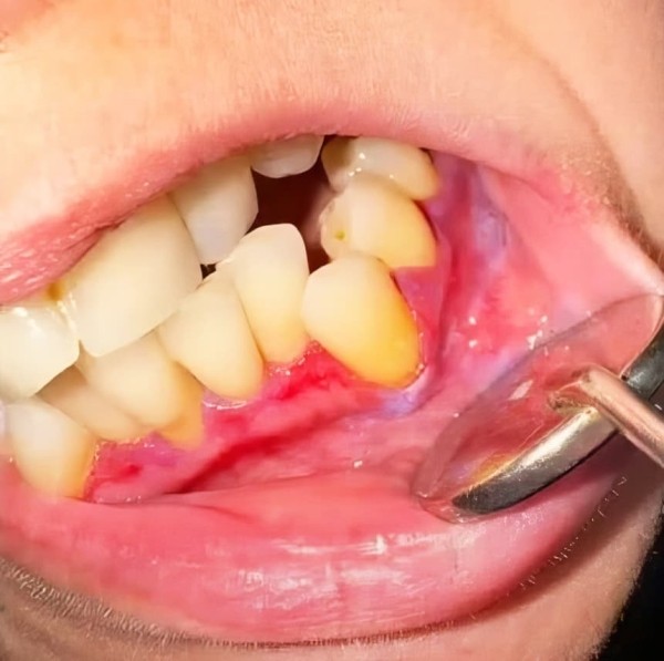 
        ГЭРБ снимает «маску»: стоматологические проявления, под которыми прячется заболевание + аудио                
        
        