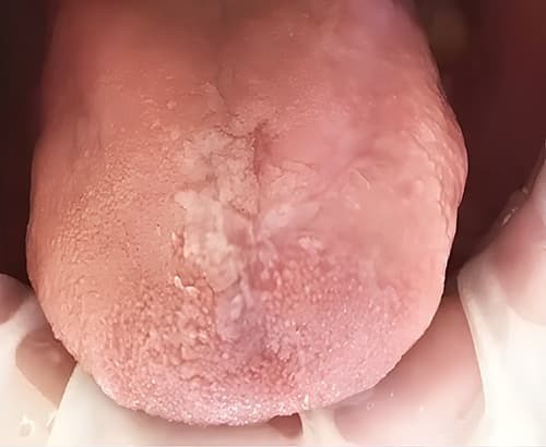 
        ГЭРБ снимает «маску»: стоматологические проявления, под которыми прячется заболевание + аудио                
        
        