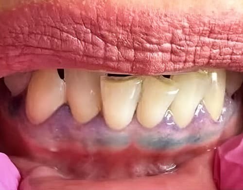 
        ГЭРБ снимает «маску»: стоматологические проявления, под которыми прячется заболевание + аудио                
        
        