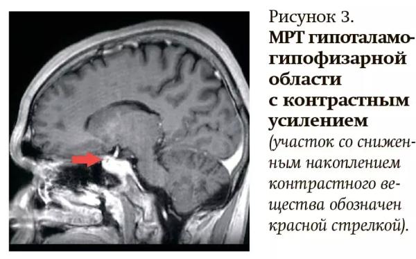 Как не пропустить болезнь Кушинга у детей?
Как не пропустить болезнь Кушинга у детей?