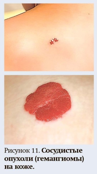 Геморрагический синдром: клиническая оценка и тесты
Геморрагический синдром: клиническая оценка и тесты