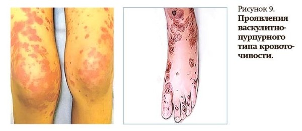 Геморрагический синдром: клиническая оценка и тесты
Геморрагический синдром: клиническая оценка и тесты