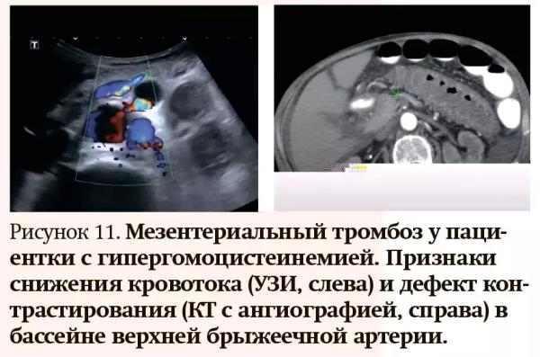 
        Лучевая диагностика при кровотечениях и тромбозах: плюсы и минусы разных методов                    