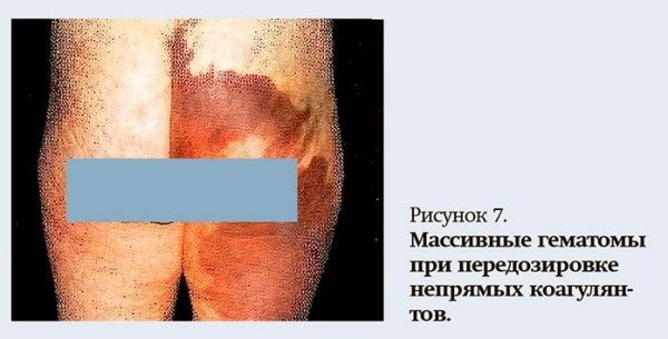 Геморрагический синдром: клиническая оценка и тесты
Геморрагический синдром: клиническая оценка и тесты