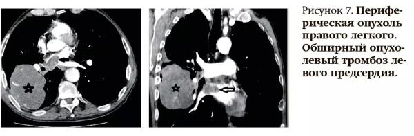 
        Лучевая диагностика при кровотечениях и тромбозах: плюсы и минусы разных методов                    
