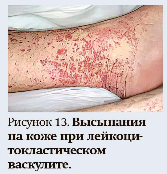 Геморрагический синдром: клиническая оценка и тесты
Геморрагический синдром: клиническая оценка и тесты