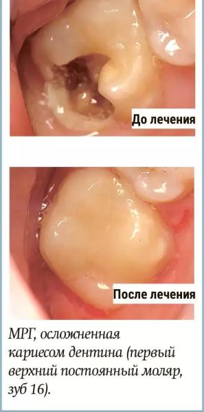 
        Диагностика и лечение молярно-резцовой гипоминерализации у детей + аудио                
        
        