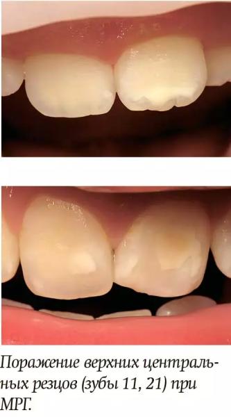 
        Диагностика и лечение молярно-резцовой гипоминерализации у детей + аудио                
        
        
