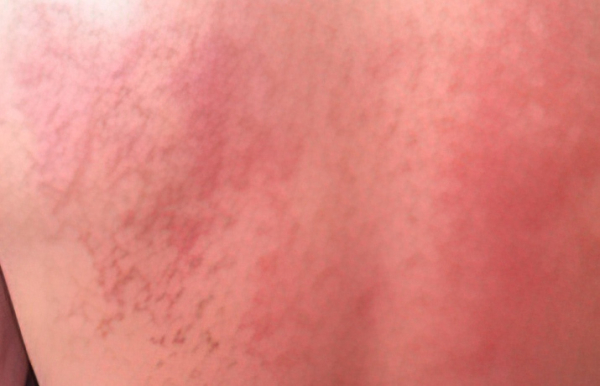 
        Фотодерматозы: фототоксические ожоги, аллергические реакции и солнечная крапивница                    