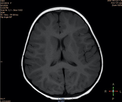 
			Пароксизмальные состояния у детей неэпилептического характера		