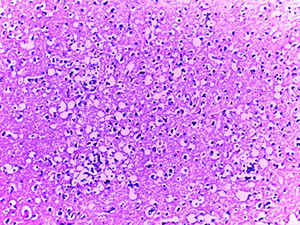 
			Патоморфологические изменения головного мозга при COVID-19		