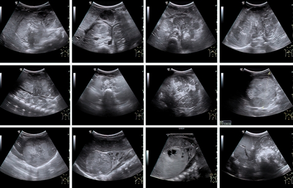 
			Нейробластома у детей: пути снижения запущенных случаев		