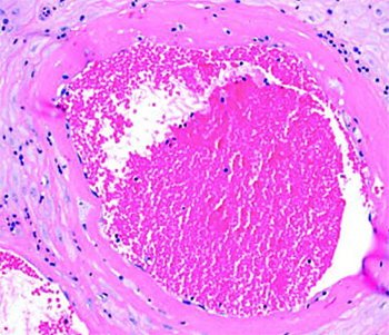 
			Патология плаценты при COVID-19		