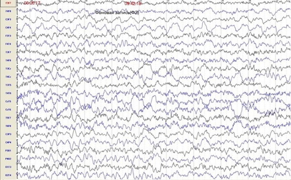 
			Пароксизмальные состояния у детей неэпилептического характера		