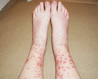 Дерматологические осложнения COVID-19 и тактика ведения пациентов с заболеваниями кожи
Дерматологические осложнения COVID-19 и тактика ведения пациентов с заболеваниями кожи