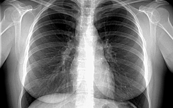 
			Саркоидоз: нерешенные задачи		