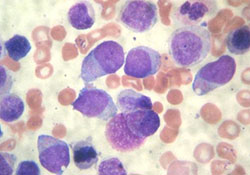 Острый миелоидный лейкоз у детей
Острый миелоидный лейкоз у детей