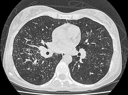 
			Саркоидоз: нерешенные задачи		