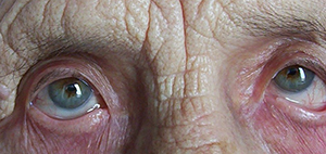 Лечение слезотечения. Часть 2
Лечение слезотечения. Часть 2