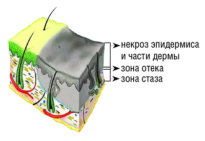 
			Ожоги: принципы диагностики и выбор тактики лечения		