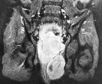 Нейрогенный мочевой пузырь
Нейрогенный мочевой пузырь