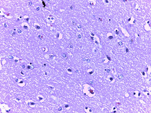 
			Патоморфологические изменения головного мозга при COVID-19		